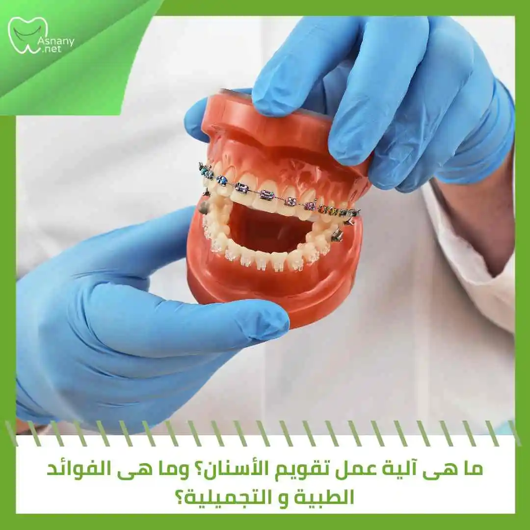 ما هى آلية عمل تقويم الأسنان؟ وما هى الفوائد الطبية و التجميلية؟ 