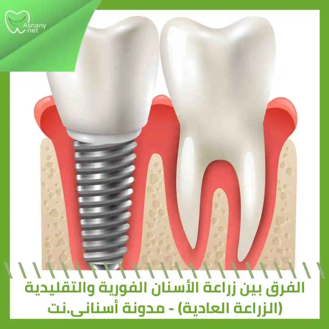 الفرق بين زراعة الأسنان الفورية والتقليدية (العادية)