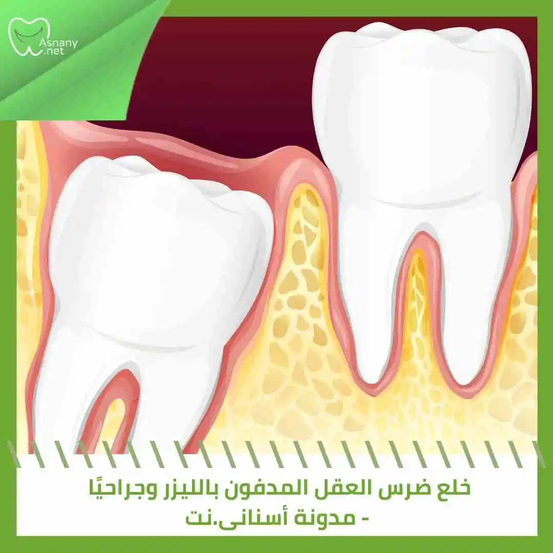 خلع ضرس العقل المدفون بالليزر وجراحيًا – الكيفية و المضاعفات