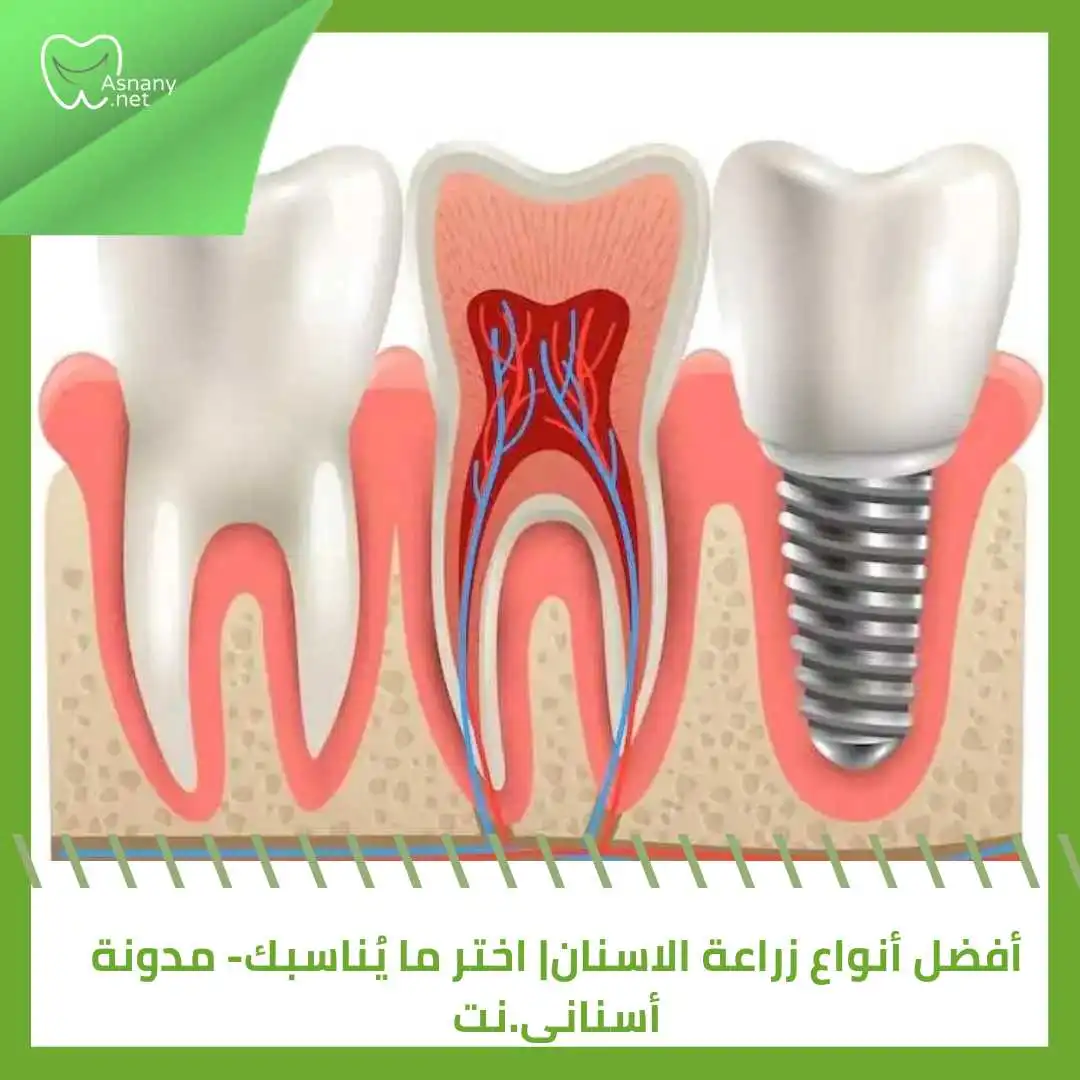 أفضل أنواع زراعة الأسنان عالمياً | اختر ما يُناسبك