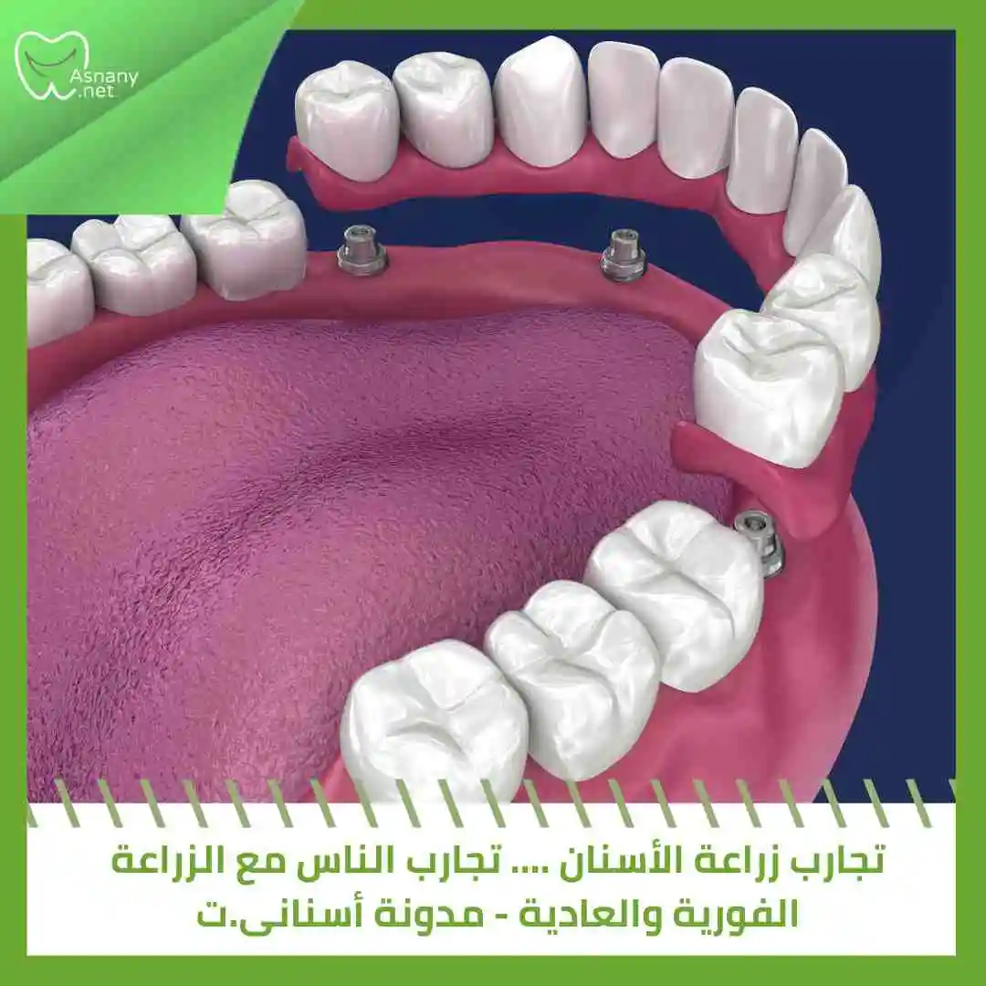 تجارب زراعة الأسنان …. تجارب الناس مع الزراعة الفورية والعادية