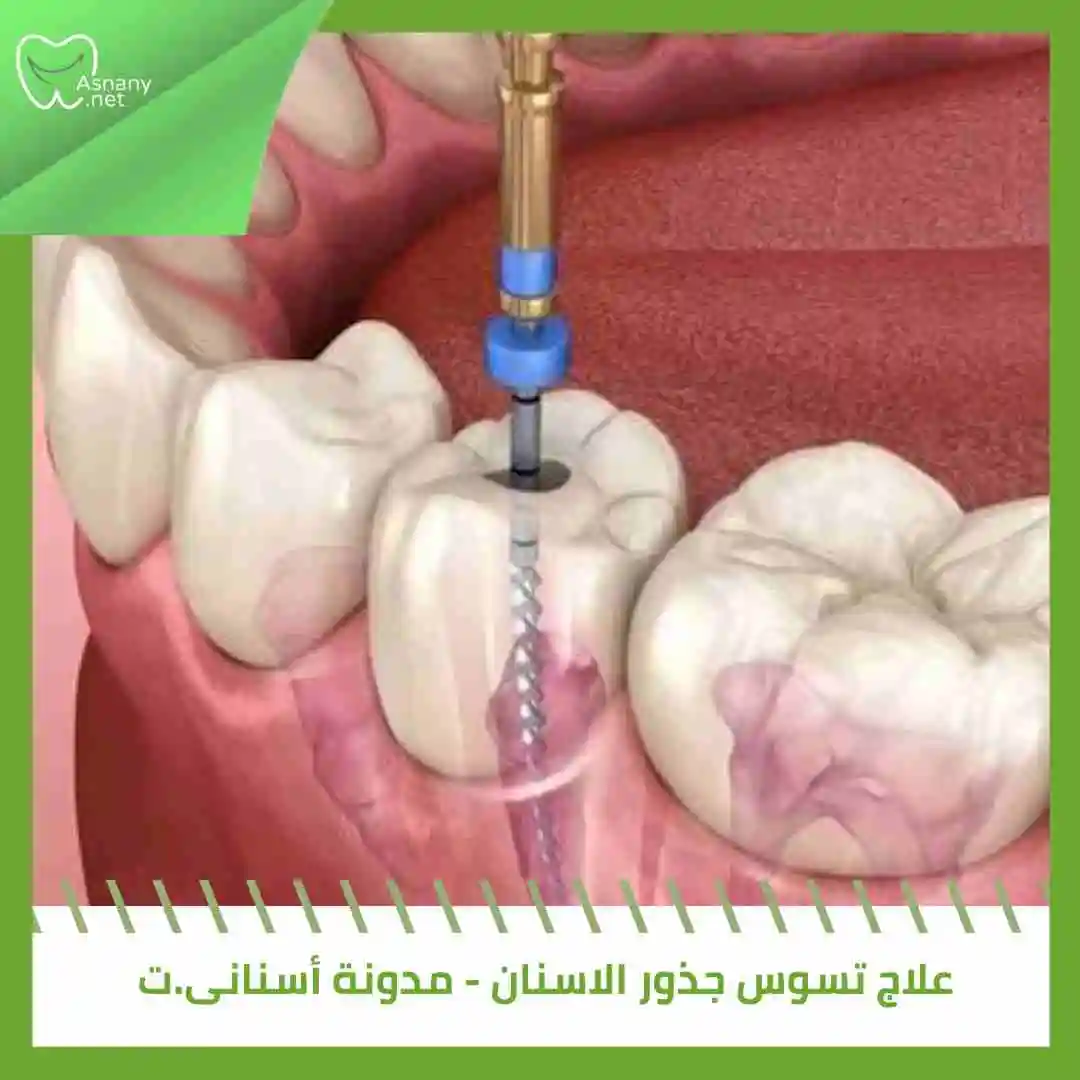 علاج تسوس جذور الاسنان