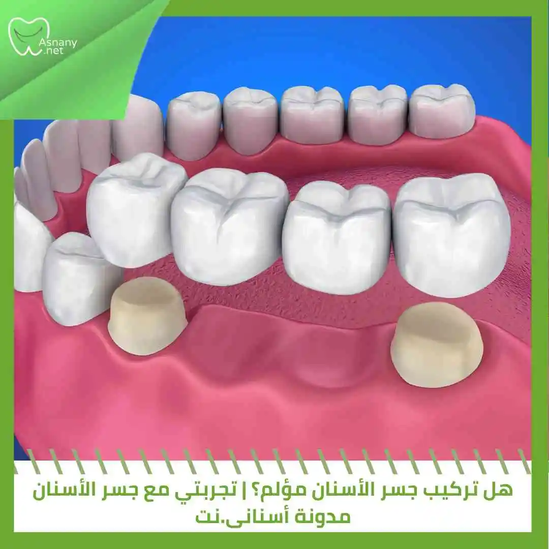 هل تركيب جسر الأسنان مؤلم؟ | تجربتي مع جسر الأسنان