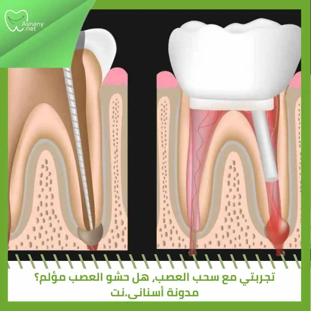 تجربتي مع سحب العصب، هل حشو العصب مؤلم؟