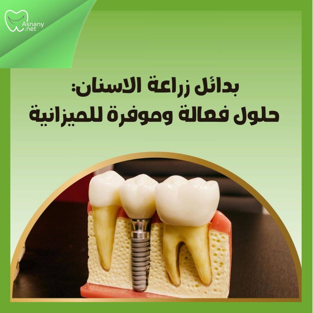 بدائل زراعة الأسنان: حلول فعالة لاستعادة الأسنان