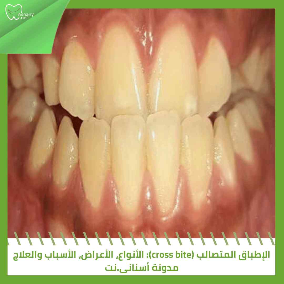 الإطباق المتصالب (cross bite): الأنواع، الأعراض، الأسباب والعلاج