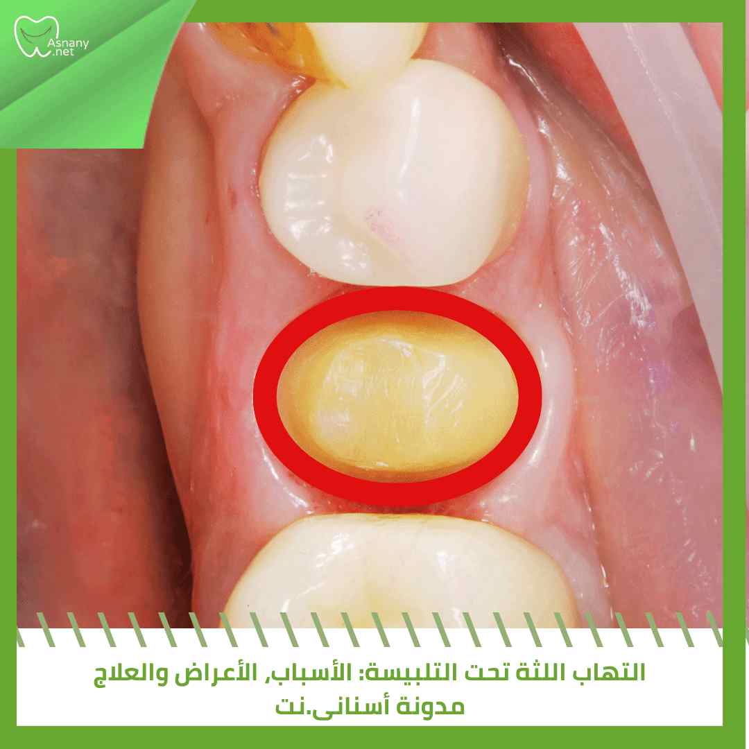 التهاب اللثة تحت التلبيسة: الأسباب، الأعراض والعلاج