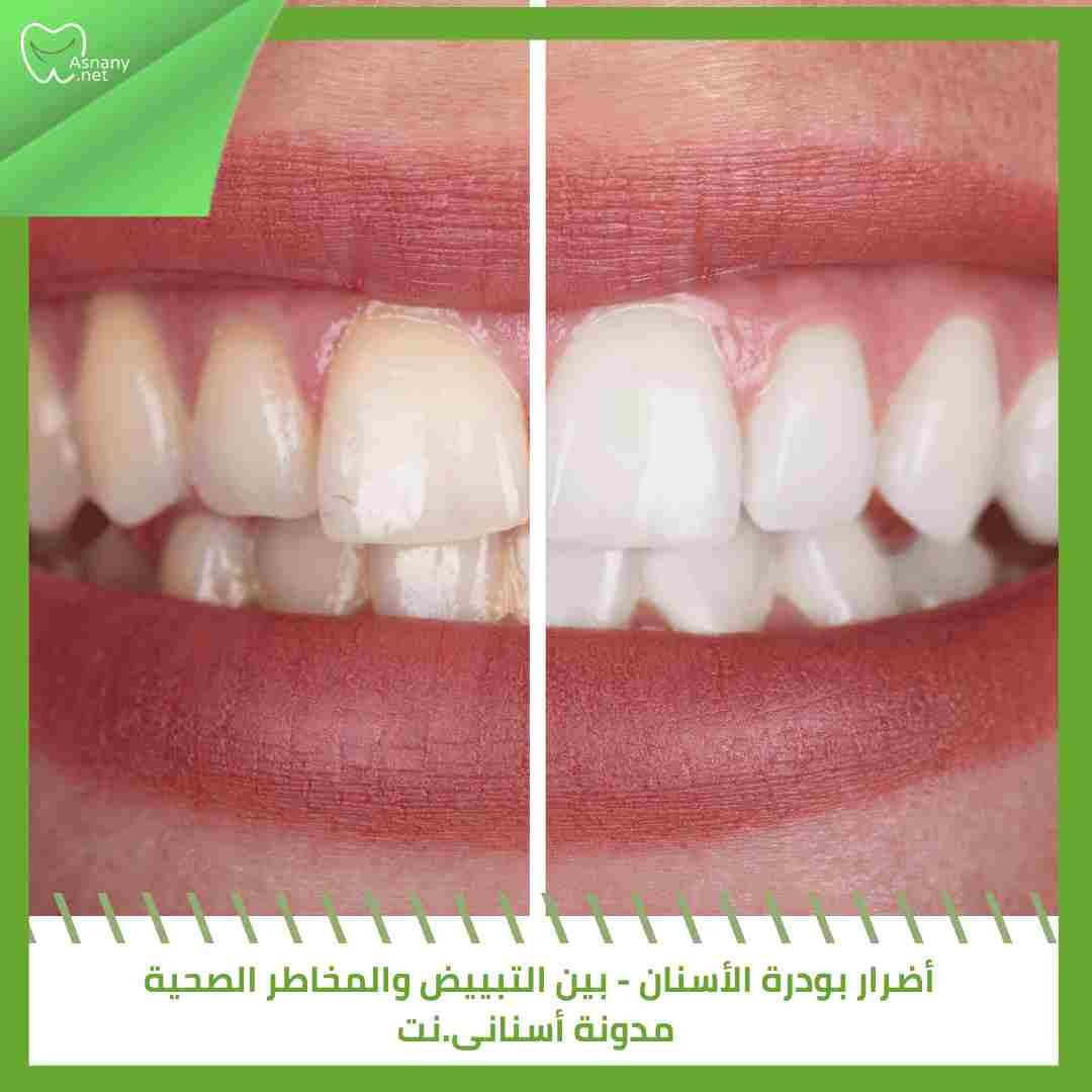 أضرار بودرة الأسنان – بين التبييض والمخاطر الصحية