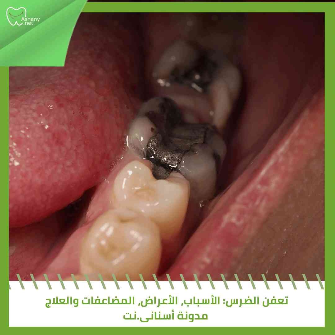 تعفن الضرس: الأسباب، الأعراض، المضاعفات والعلاج
