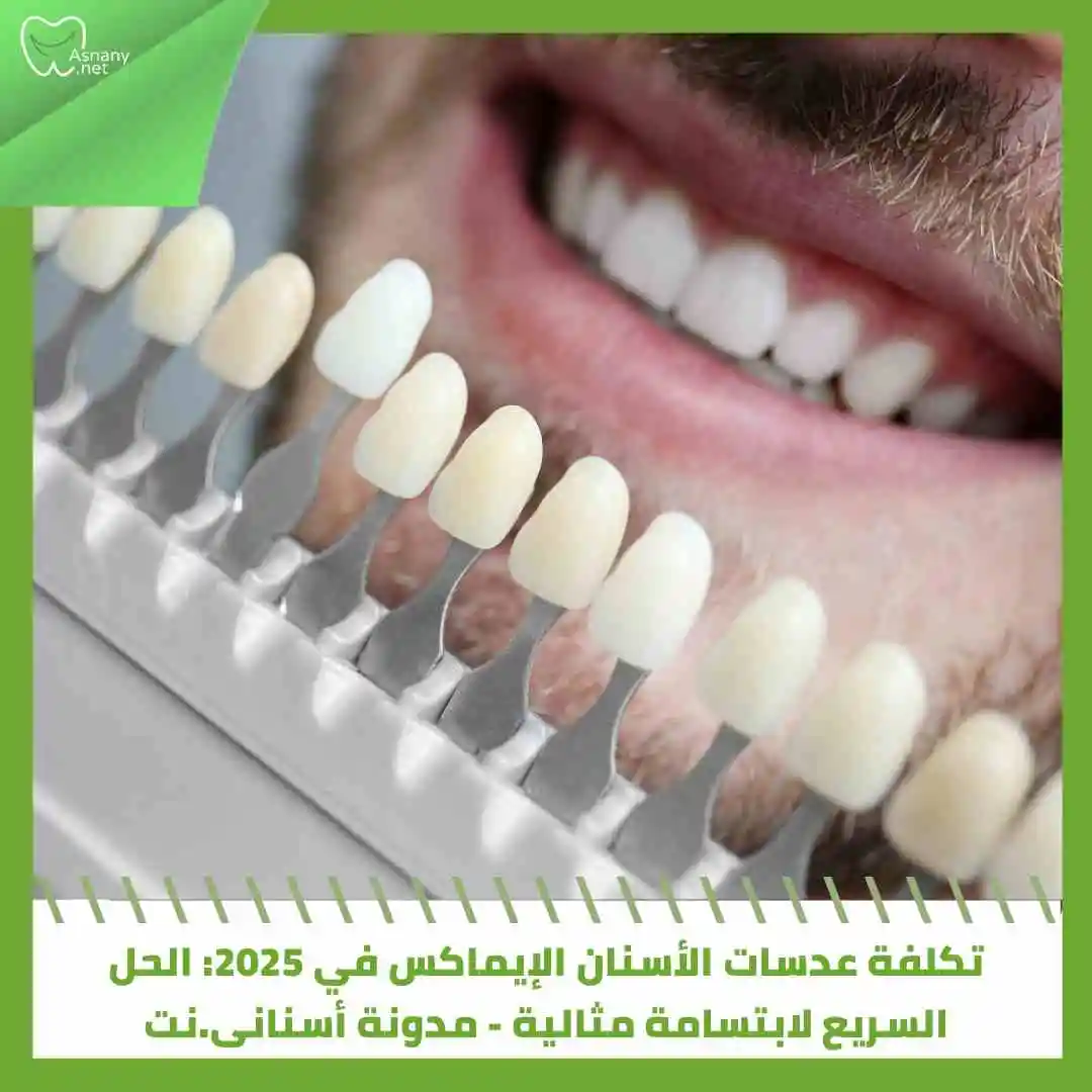 عدسات الأسنان الإيماكس: المميزات والعيوب والأسعار