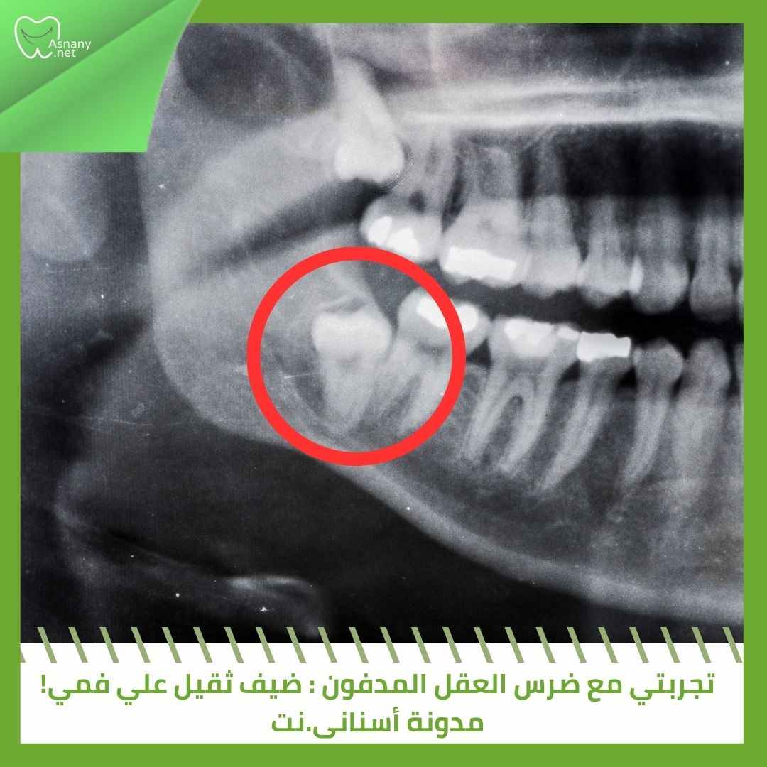 تجربتي مع ضرس العقل المدفون : ضيف ثقيل علي فمي!   
