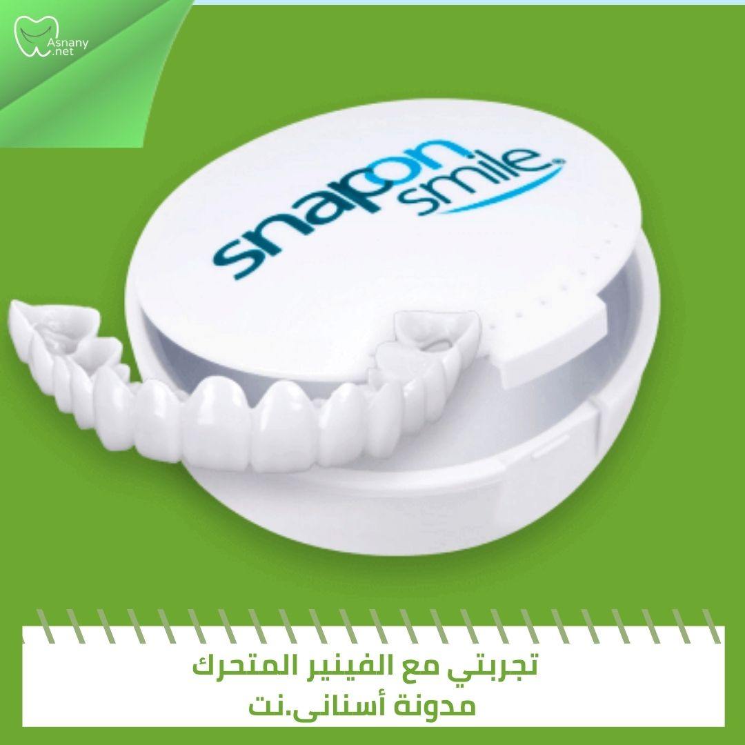 تجربتي مع الفينير المتحرك