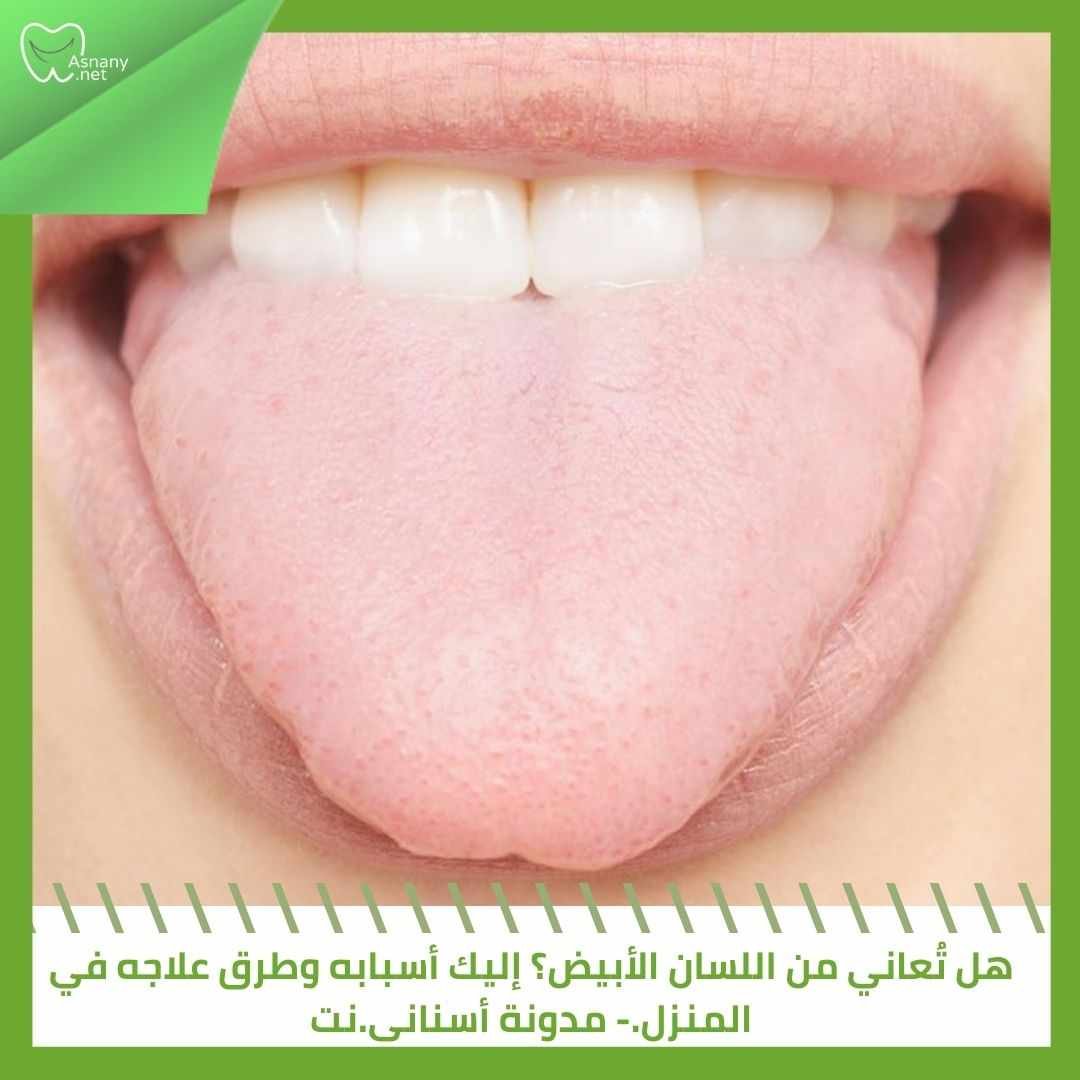 هل تُعاني من اللسان الأبيض؟ إليك أسبابه وطرق علاجه في المنزل.